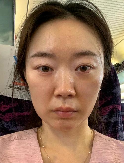 脸部伤疤整形要多少钱