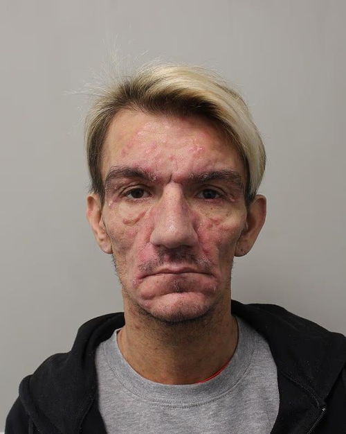 龅牙矫正要多少钱 龅牙矫正多少钱价格表2023